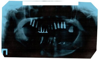 Ренгеновский снимок зубов